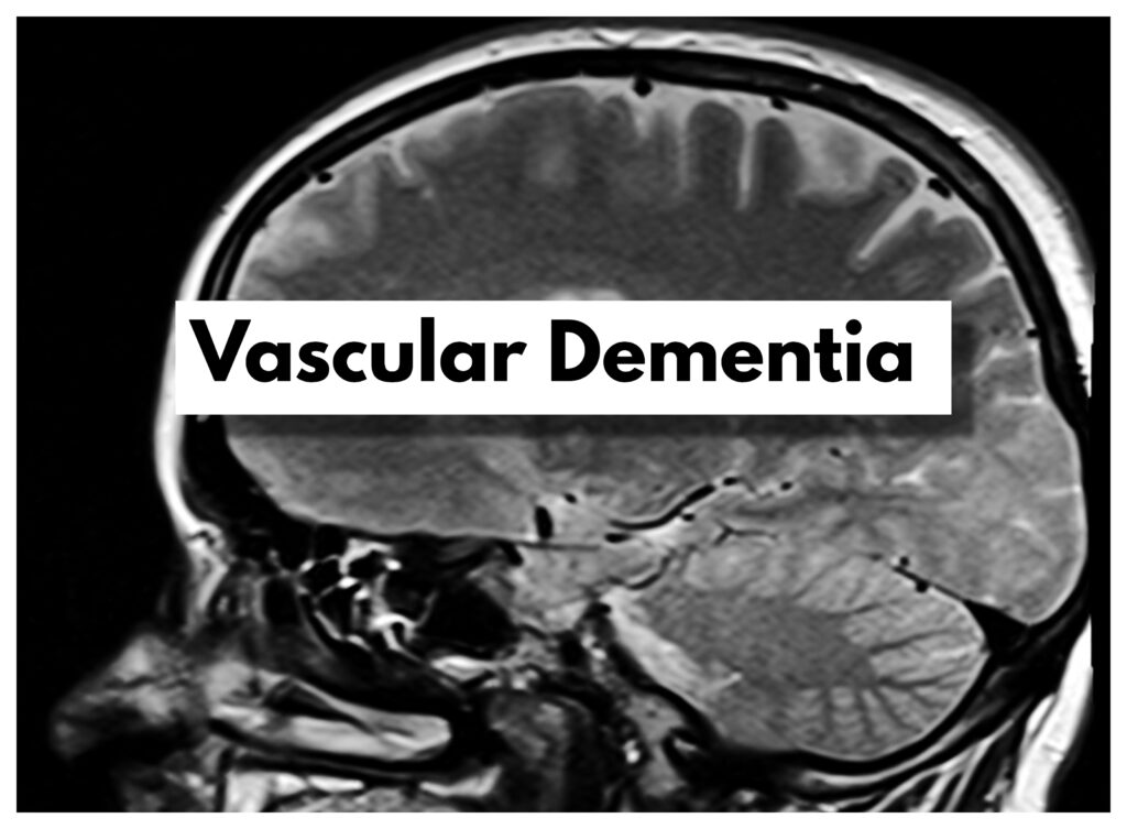 Vascular dementia is a consequence of multiple cerebral infarcts that cause vascular impairments to the brain leading to a lack of oxygen and glucose supply.