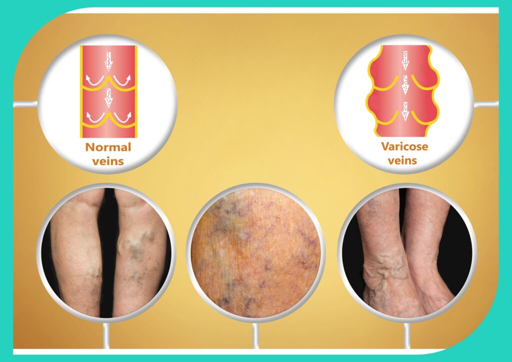 Varicose veins are swollen and twisted leg veins caused by weakened valves.